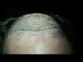 baldness treatment india
